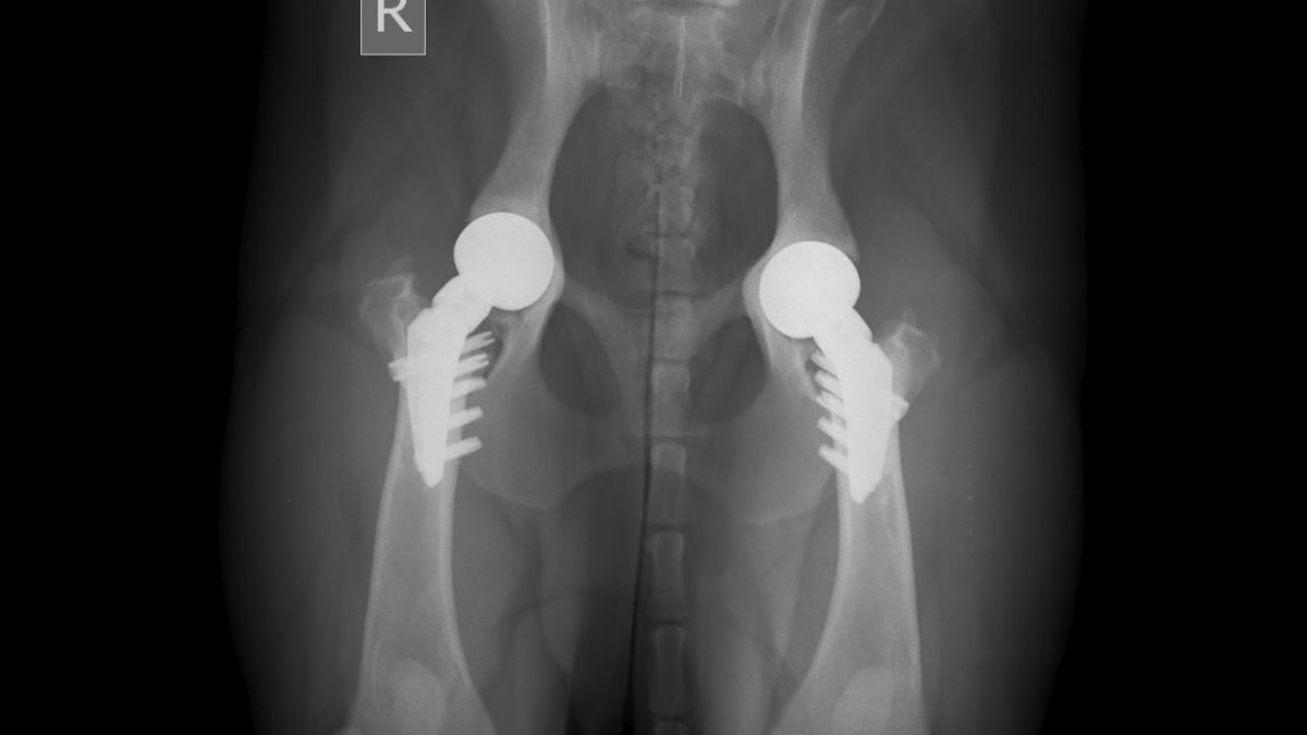 Partial Hip Vs Total Hip Joint Replacement