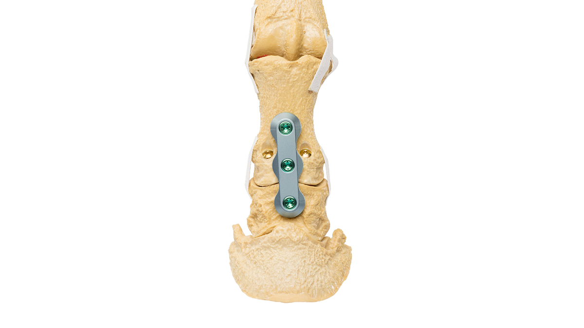 PIP - Proximal Interphalangeal Arthrodesis | KYON